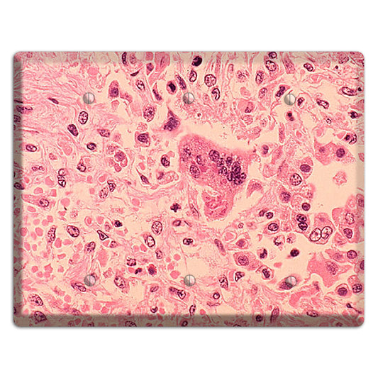 Measles Pneumonia 3 Blank Wallplate